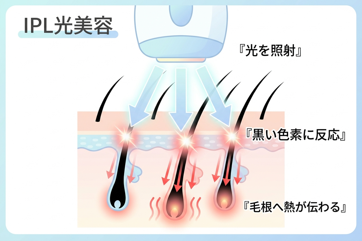 IPLの光が毛の黒い色素に反応する光美容の仕組みの図解