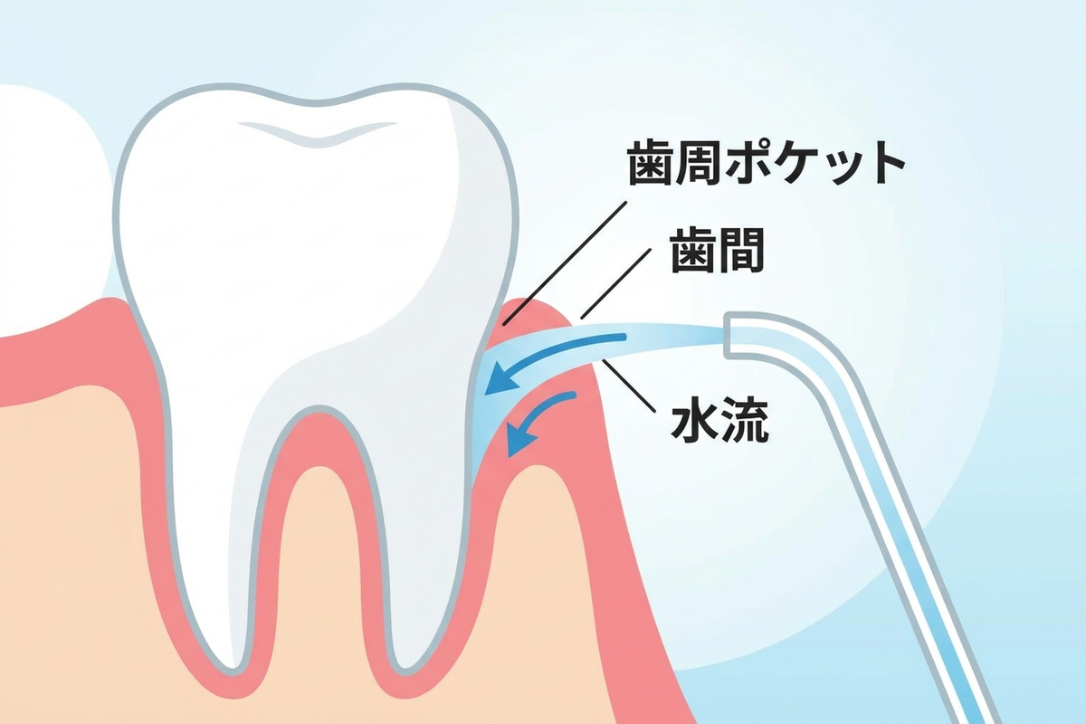 歯と歯茎の断面図と口腔洗浄器の水流をイメージした説明図